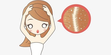 我们不能没有头皮屑？ 第1张