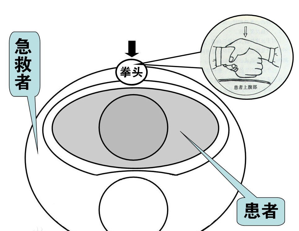 什么是海姆立克急救法？记住这些急救步骤，关键时刻能救命！ 第3张
