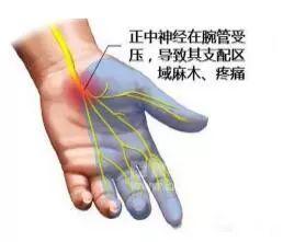 鼠标手怎么矫正最有效（鼠标手的快速康复方法） 第7张