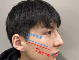 咬肌发达怎么处理 第1张