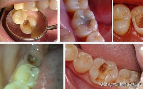 补一颗牙齿大概多少钱左右（搞清楚这2个门道能省不少）