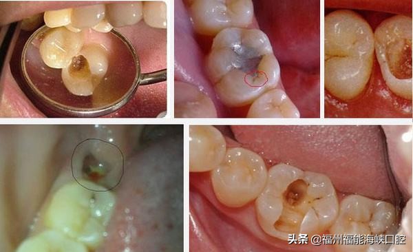 补牙太贵了？过来人表示：搞清楚2个门道后，能省不少 第1张