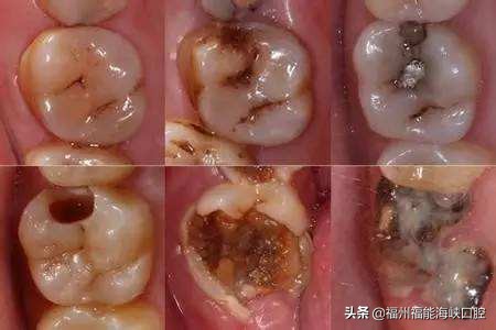 补牙太贵了？过来人表示：搞清楚2个门道后，能省不少 第3张