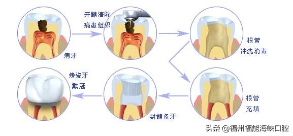 补牙太贵了？过来人表示：搞清楚2个门道后，能省不少 第9张