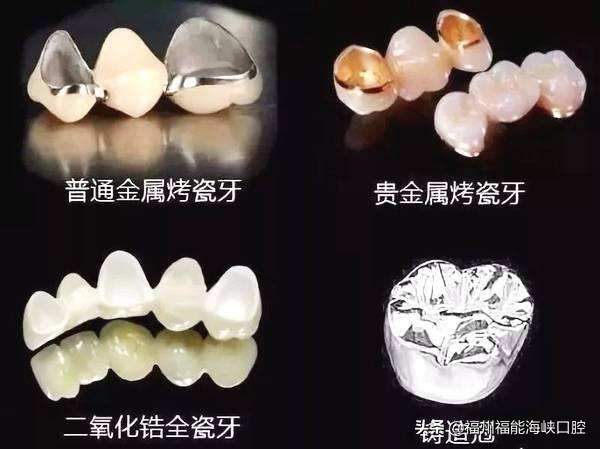 补牙太贵了？过来人表示：搞清楚2个门道后，能省不少 第13张