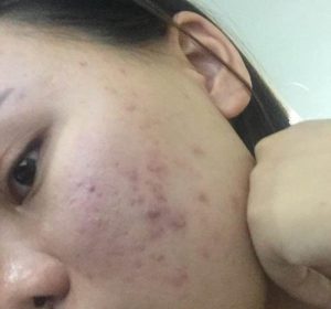 一到夏天脸上爆痘，是这几件事没做好 第1张
