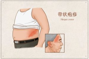带状疱疹太可怕,生活中该如何预防？ 第1张