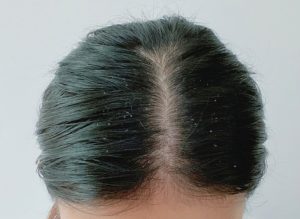 头皮屑太多惹人烦，试一试这些小妙招！ 第1张