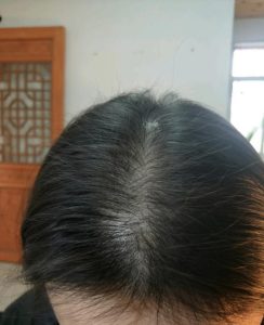 如何快速根治脱发？这些土方法最可靠！ 第1张